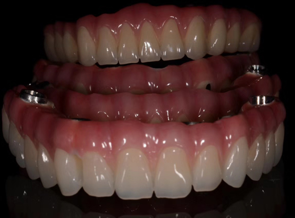 Implants